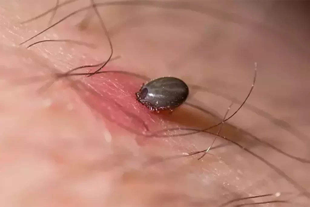 Kene ısırığı sonucu Kırım Kongo Kanamalı Ateşi'ne yakalanan adam hayatını kaybetti